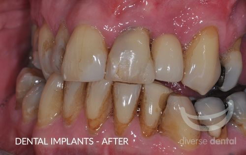 Implants After Case 2.jpg