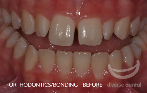 Orthodontics-Bonding-Before.png