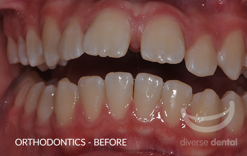Orthodontics-Before2.png
