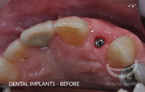 Implants Before Case 2.jpg
