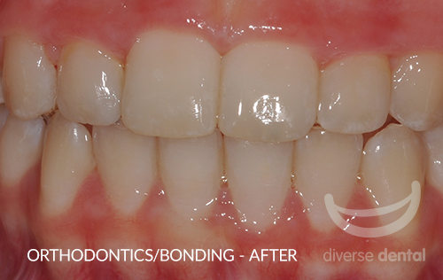 Orthodontics-Bonding-After.png