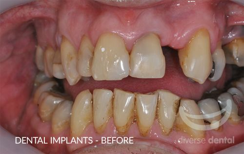 Implants Before Case 1.jpg