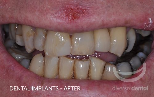 Implants After Case 1.jpg